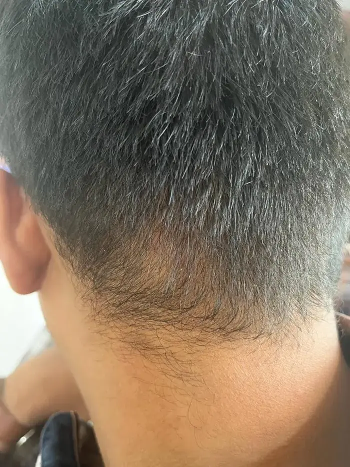 Alopecia Areata After